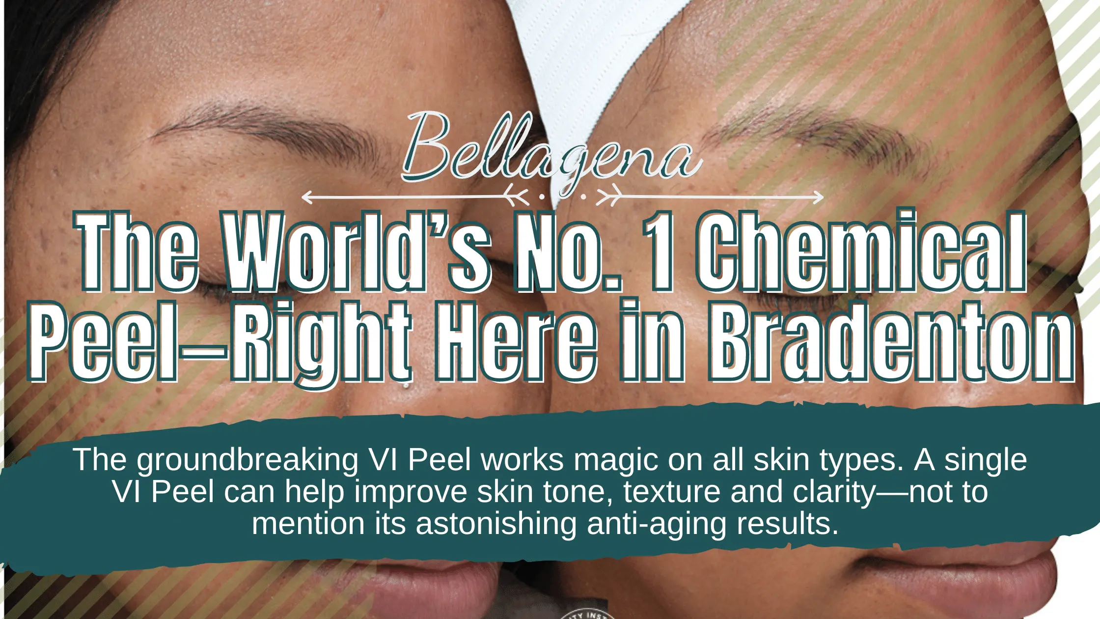 The World’s No. 1 Chemical Peel—Right Here in Bradenton